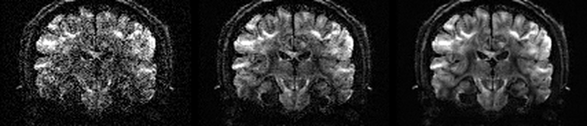 b=3000 s/mm² volume at 1.5 mm: input (left), MRtrix3 MPPCA (middle), svht_denoise (right)