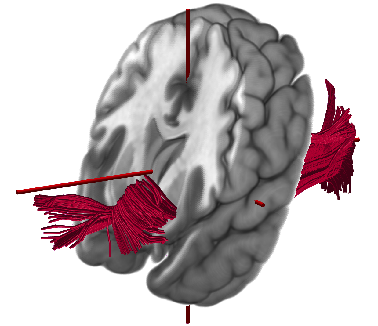 Diffusion tractography streamlines passing through an anatomical brain model
