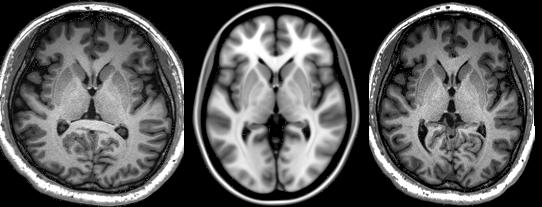 Linear spatial normalization: native image (left), population template (middle), and transformed image (right)